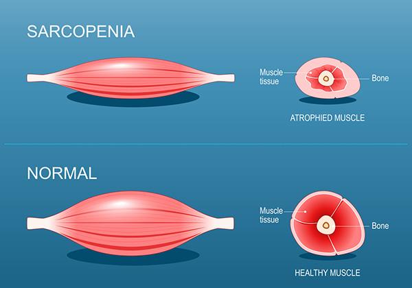 肌少症怎麼判斷？